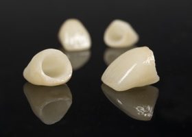 当院のセラミック矯正の強みをご紹介