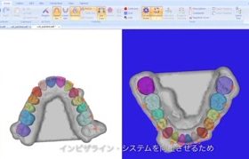 マウスピース矯正の3Dシミュレーションについて