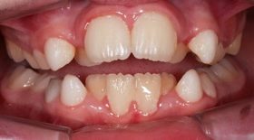 八重歯は子供のうちに矯正した方がいいの？