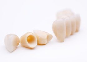 セラミックの差し歯を使った「セラミック矯正」ってどんな歯科矯正？